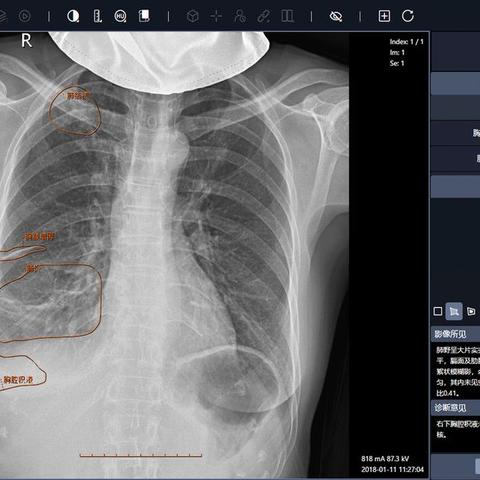 日本写真偶像胸腔X光照片为何引网友热议？