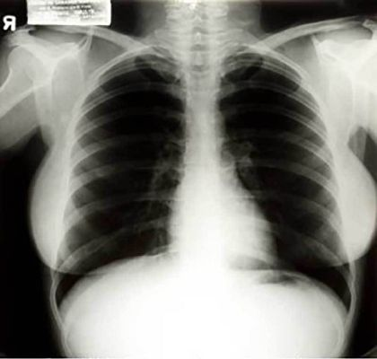 网友为何热议日本写真偶像的胸腔X光照片