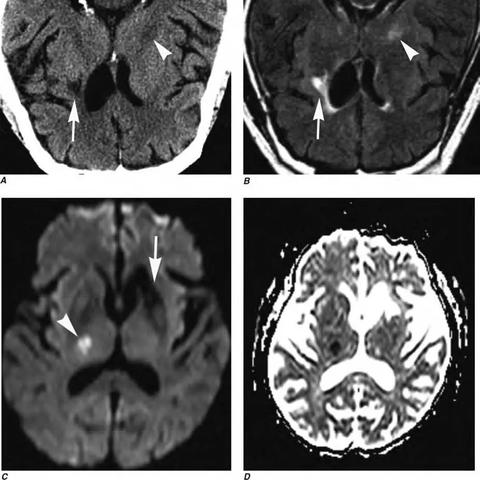 硬化之壳是什么？全类型解析+热门游戏刷取&高效应用实战指南