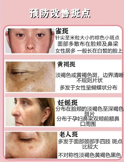 别瞎用淡斑霜！不同类型雀斑针对性去除方案｜2026年实测指南